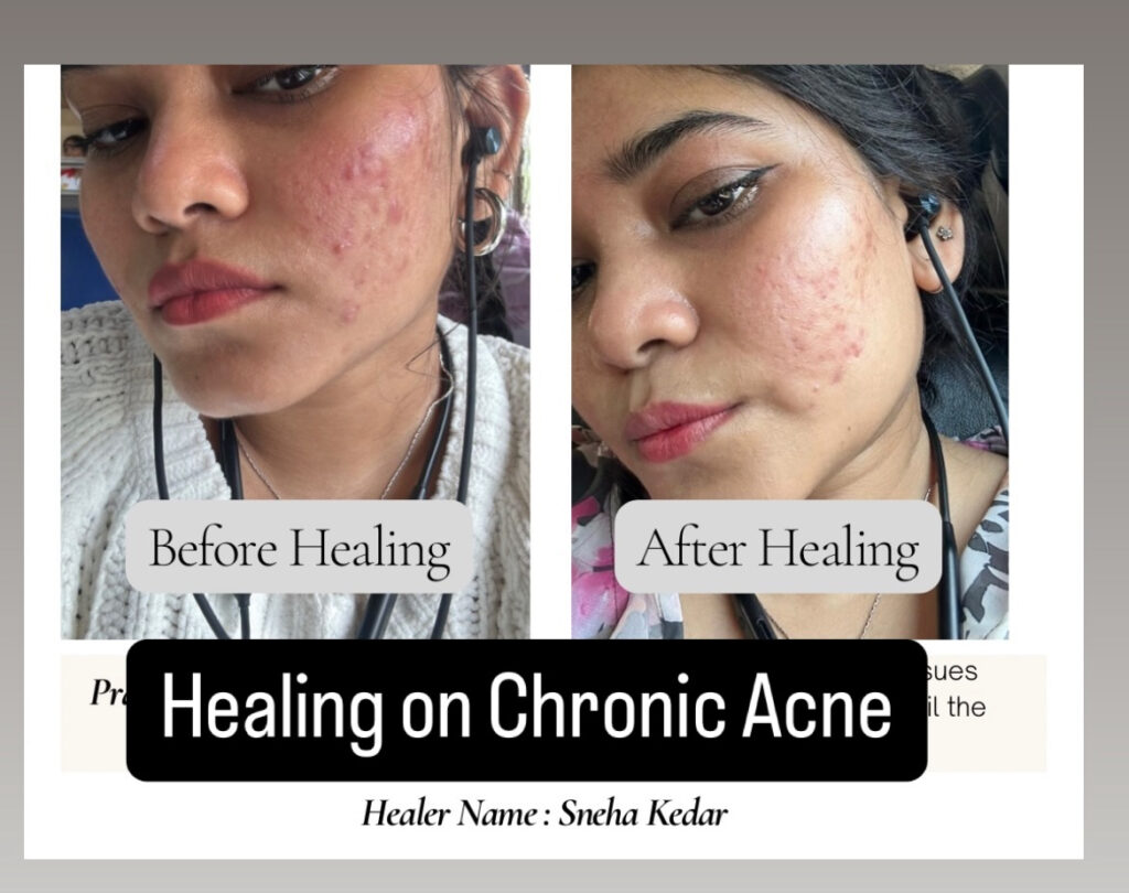 Healing of Chronic Acne through Pranic Healing Review